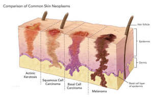 skin-neoplasm-comparison